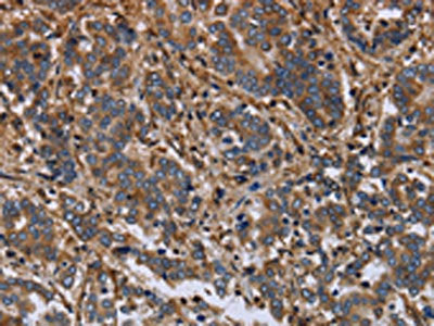 The image on the left is immunohistochemistry of paraffin-embedded Human liver cancer tissue using CSB-PA985162(FLNA Antibody) at dilution 1/40, on the right is treated with fusion protein. (Original magnification: ×200)