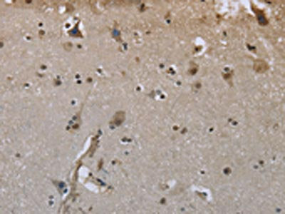 The image on the left is immunohistochemistry of paraffin-embedded Human brain tissue using CSB-PA985220(GYS1 Antibody) at dilution 1/50, on the right is treated with fusion protein. (Original magnification: ×200)