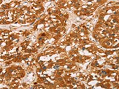 The image on the left is immunohistochemistry of paraffin-embedded Human thyroid cancer tissue using CSB-PA985242(SPN Antibody) at dilution 1/60, on the right is treated with fusion protein. (Original magnification: ×200)
