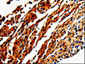 The image is immunohistochemistry of paraffin-embedded Human cervical cancer tissue using CSB-PA985327(ADD1 Antibody) at dilution 1/50. (Original magnification: ×200)
