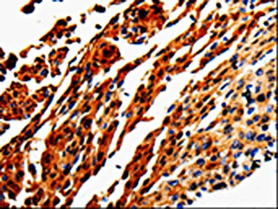 The image is immunohistochemistry of paraffin-embedded Human cervical cancer tissue using CSB-PA985327(ADD1 Antibody) at dilution 1/50. (Original magnification: ×200)