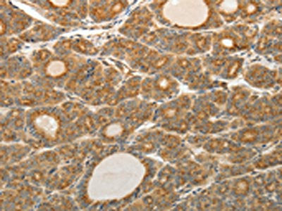 The image on the left is immunohistochemistry of paraffin-embedded Human thyroid cancer tissue using CSB-PA985349(AKR1C1 Antibody) at dilution 1/20, on the right is treated with synthetic peptide. (Original magnification: ×200)