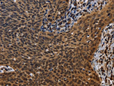 The image on the left is immunohistochemistry of paraffin-embedded Human cervical cancer tissue using CSB-PA985521(FHL3 Antibody) at dilution 1/40, on the right is treated with fusion protein. (Original magnification: ×200)