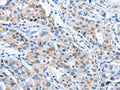 The image on the left is immunohistochemistry of paraffin-embedded Human lung cancer tissue using CSB-PA985538(IMMT Antibody) at dilution 1/70, on the right is treated with fusion protein. (Original magnification: ×200)