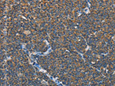 The image on the left is immunohistochemistry of paraffin-embedded Human lymphoma tissue using CSB-PA986111(SEPT9 Antibody) at dilution 1/15, on the right is treated with fusion protein. (Original magnification: ×200)