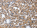 The image on the left is immunohistochemistry of paraffin-embedded Human thyroid cancer tissue using CSB-PA986354(CDK5RAP3 Antibody) at dilution 1/40, on the right is treated with fusion protein. (Original magnification: ×200)