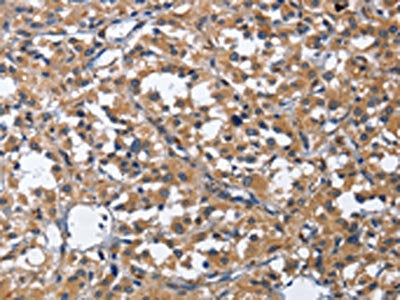 The image on the left is immunohistochemistry of paraffin-embedded Human thyroid cancer tissue using CSB-PA986354(CDK5RAP3 Antibody) at dilution 1/40, on the right is treated with fusion protein. (Original magnification: ×200)