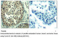 Immunohistochemical analysis of paraffin-embedded human breast carcinoma tissueusing Cyclin E1 (Ab-395) Antibody.