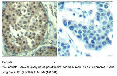 Immunohistochemical analysis of paraffin-embedded human breast carcinoma tissueusing Cyclin E1 (Ab-395) Antibody.