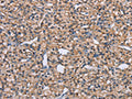 The image on the left is immunohistochemistry of paraffin-embedded Human prostate cancer tissue using CSB-PA986639(ADAM29 Antibody) at dilution 1/40, on the right is treated with synthetic peptide. (Original magnification: ×200)