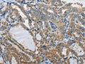 The image on the left is immunohistochemistry of paraffin-embedded Human thyroid cancer tissue using CSB-PA986806(GZMB Antibody) at dilution 1/15, on the right is treated with fusion protein. (Original magnification: ×200)