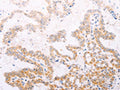 The image on the left is immunohistochemistry of paraffin-embedded Human thyroid cancer tissue using CSB-PA986893(TYR Antibody) at dilution 1/30, on the right is treated with fusion protein. (Original magnification: ×200)