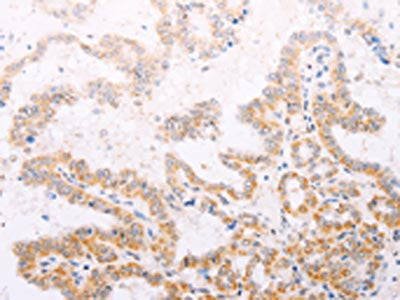 The image on the left is immunohistochemistry of paraffin-embedded Human thyroid cancer tissue using CSB-PA986893(TYR Antibody) at dilution 1/30, on the right is treated with fusion protein. (Original magnification: ×200)