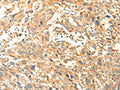 The image on the left is immunohistochemistry of paraffin-embedded Human esophagus cancer tissue using CSB-PA986930(AGRN Antibody) at dilution 1/30, on the right is treated with synthetic peptide. (Original magnification: ×200)