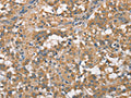 The image on the left is immunohistochemistry of paraffin-embedded Human thyroid cancer tissue using CSB-PA986935(PLEKHO1 Antibody) at dilution 1/70, on the right is treated with fusion protein. (Original magnification: ×200)