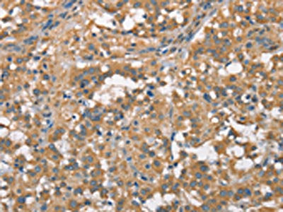 The image on the left is immunohistochemistry of paraffin-embedded Human thyroid cancer tissue using CSB-PA986935(PLEKHO1 Antibody) at dilution 1/70, on the right is treated with fusion protein. (Original magnification: ×200)