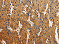 The image is immunohistochemistry of paraffin-embedded Human liver cancer tissue using CSB-PA987034(CALU Antibody) at dilution 1/40. (Original magnification: ×200)
