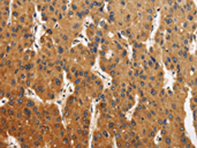 The image is immunohistochemistry of paraffin-embedded Human liver cancer tissue using CSB-PA987034(CALU Antibody) at dilution 1/40. (Original magnification: ×200)