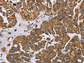 The image on the left is immunohistochemistry of paraffin-embedded Human ovarian cancer tissue using CSB-PA987170(NOV Antibody) at dilution 1/25, on the right is treated with fusion protein. (Original magnification: ×200)