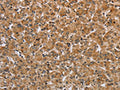 The image on the left is immunohistochemistry of paraffin-embedded Human prostate cancer tissue using CSB-PA987228(IKBKE Antibody) at dilution 1/25, on the right is treated with fusion protein. (Original magnification: ×200)