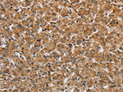 The image on the left is immunohistochemistry of paraffin-embedded Human prostate cancer tissue using CSB-PA987228(IKBKE Antibody) at dilution 1/25, on the right is treated with fusion protein. (Original magnification: ×200)