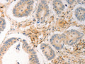 The image on the left is immunohistochemistry of paraffin-embedded Human colon cancer tissue using CSB-PA987235(AVPR2 Antibody) at dilution 1/30, on the right is treated with synthetic peptide. (Original magnification: ×200)