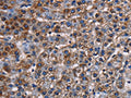 The image on the left is immunohistochemistry of paraffin-embedded Human lung cancer tissue using CSB-PA987381(KCNK1 Antibody) at dilution 1/50, on the right is treated with fusion protein. (Original magnification: ×200)