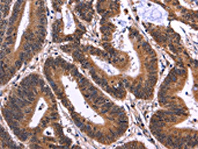 The image on the left is immunohistochemistry of paraffin-embedded Human colon cancer tissue using CSB-PA987494(MSH4 Antibody) at dilution 1/50, on the right is treated with fusion protein. (Original magnification: ×200)