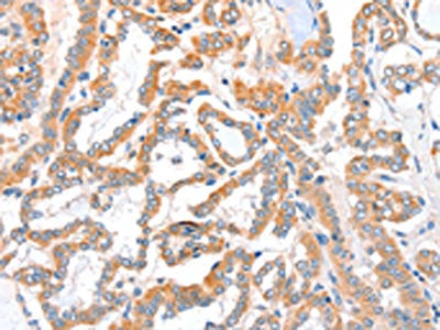 The image on the left is immunohistochemistry of paraffin-embedded Human thyroid cancer tissue using CSB-PA988330(ACSBG1 Antibody) at dilution 1/40, on the right is treated with fusion protein. (Original magnification: ×200)