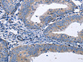 The image on the left is immunohistochemistry of paraffin-embedded Human cervical cancer tissue using CSB-PA988388(BDNF Antibody) at dilution 1/40, on the right is treated with synthetic peptide. (Original magnification: ×200)