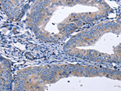 The image on the left is immunohistochemistry of paraffin-embedded Human cervical cancer tissue using CSB-PA988388(BDNF Antibody) at dilution 1/40, on the right is treated with synthetic peptide. (Original magnification: ×200)