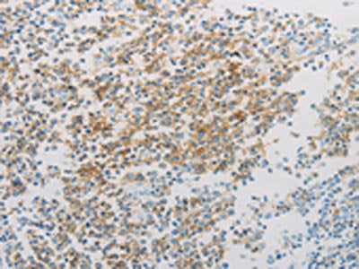 The image on the left is immunohistochemistry of paraffin-embedded Human tonsil tissue using CSB-PA988424(ADM Antibody) at dilution 1/20, on the right is treated with synthetic peptide. (Original magnification: ×200)