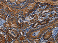 The image on the left is immunohistochemistry of paraffin-embedded Human thyroid cancer tissue using CSB-PA988465(PIDD1 Antibody) at dilution 1/30, on the right is treated with fusion protein. (Original magnification: ×200)