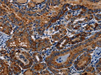 The image on the left is immunohistochemistry of paraffin-embedded Human thyroid cancer tissue using CSB-PA988465(PIDD1 Antibody) at dilution 1/30, on the right is treated with fusion protein. (Original magnification: ×200)