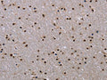 The image on the left is immunohistochemistry of paraffin-embedded Human brain tissue using CSB-PA988498(JMJD6 Antibody) at dilution 1/40, on the right is treated with fusion protein. (Original magnification: ×200)