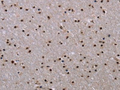 The image on the left is immunohistochemistry of paraffin-embedded Human brain tissue using CSB-PA988498(JMJD6 Antibody) at dilution 1/40, on the right is treated with fusion protein. (Original magnification: ×200)