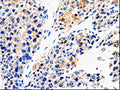 The image on the left is immunohistochemistry of paraffin-embedded Human liver cancer tissue using CSB-PA988836(ABCG2 Antibody) at dilution 1/100, on the right is treated with synthetic peptide. (Original magnification: ×200)