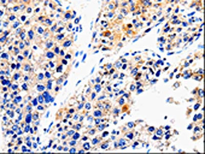 The image on the left is immunohistochemistry of paraffin-embedded Human liver cancer tissue using CSB-PA988836(ABCG2 Antibody) at dilution 1/100, on the right is treated with synthetic peptide. (Original magnification: ×200)