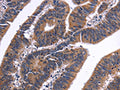 The image on the left is immunohistochemistry of paraffin-embedded Human colon cancer tissue using CSB-PA988942(NFATC3 Antibody) at dilution 1/50, on the right is treated with fusion protein. (Original magnification: ×200)