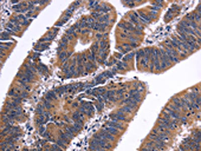 The image on the left is immunohistochemistry of paraffin-embedded Human colon cancer tissue using CSB-PA988942(NFATC3 Antibody) at dilution 1/50, on the right is treated with fusion protein. (Original magnification: ×200)