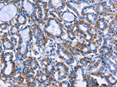 The image on the left is immunohistochemistry of paraffin-embedded Human thyroid cancer tissue using CSB-PA989166(MPO Antibody) at dilution 1/50, on the right is treated with fusion protein. (Original magnification: ×200)