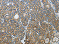 The image on the left is immunohistochemistry of paraffin-embedded Human thyroid cancer tissue using CSB-PA989223(CXCR3 Antibody) at dilution 1/20, on the right is treated with fusion protein. (Original magnification: ×200)