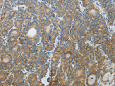 The image on the left is immunohistochemistry of paraffin-embedded Human thyroid cancer tissue using CSB-PA989223(CXCR3 Antibody) at dilution 1/20, on the right is treated with fusion protein. (Original magnification: ×200)