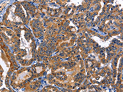 The image on the left is immunohistochemistry of paraffin-embedded Human thyroid cancer tissue using CSB-PA989887(MUSK Antibody) at dilution 1/40, on the right is treated with fusion protein. (Original magnification: ×200)