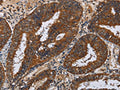 The image on the left is immunohistochemistry of paraffin-embedded Human colon cancer tissue using CSB-PA990038(KLK11 Antibody) at dilution 1/50, on the right is treated with fusion protein. (Original magnification: ×200)