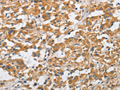 The image on the left is immunohistochemistry of paraffin-embedded Human thyroid cancer tissue using CSB-PA990163(ARHGAP15 Antibody) at dilution 1/50, on the right is treated with fusion protein. (Original magnification: ×200)