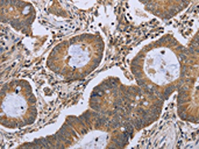The image on the left is immunohistochemistry of paraffin-embedded Human colon cancer tissue using CSB-PA990771(FKBP8 Antibody) at dilution 1/50, on the right is treated with fusion protein. (Original magnification: ×200)