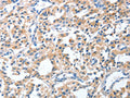 The image on the left is immunohistochemistry of paraffin-embedded Human thyroid cancer tissue using CSB-PA990883(CGB Antibody) at dilution 1/40, on the right is treated with fusion protein. (Original magnification: ×200)
