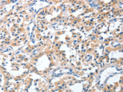 The image on the left is immunohistochemistry of paraffin-embedded Human thyroid cancer tissue using CSB-PA990883(CGB Antibody) at dilution 1/40, on the right is treated with fusion protein. (Original magnification: ×200)