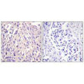 Immunohistochemistry analysis of paraffin-embedded human breast carcinoma tissue using UBE1L antibody.